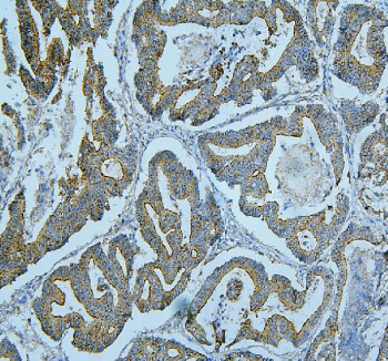 IHC staining of FFPE human intestinal cancer tissue with ALIX antibody. HIER: boil tissue sections in pH8 EDTA buffer for 20 min and allow to cool before testing.