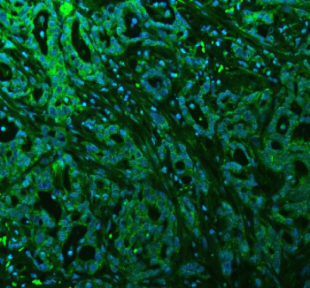 Immunofluorescent staining of FFPE human pancreatic cancer tissue with ALIX antibody (green) and DAPI nuclear stain (blue). HIER: steam section in pH8 EDTA buffer for 20 min.