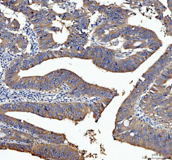 Immunohistochemical staining of FFPE human rectal cancer tissue with Smac antibody, HRP-secondary and DAB substrate. HIER: boil tissue sections in pH8 EDTA for 20 min and allow to cool before testing.