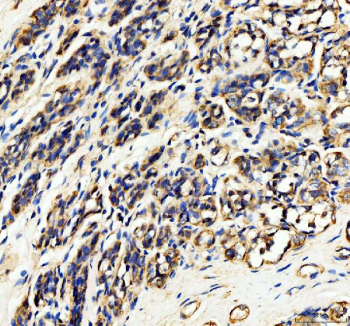 IHC staining of FFPE human breast cancer tissue with HDAC6 antibody, HRP-secondary and DAB substrate. HIER: boil tissue sections in pH8 EDTA for 20 min and allow to cool before testing.