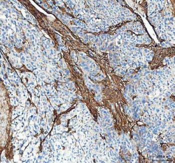 Collagen I Antibody / Extracellular Matrix Protein Human Bladder Urothelial Carcinoma IHC. Immunohistochemical staining of FFPE human bladder urothelial carcinoma tissue using Collagen I Antibody / Extracellular Matrix Protein. Collagen I expression is observed predominantly within the stromal extracellular matrix surrounding invasive tumor nests, consistent with its role in maintaining connective tissue architecture and contributing to the desmoplastic tumor microenvironment. Heat-induced epitope retrieval was performed by boiling tissue sections in pH 8 EDTA for 20 minutes followed by cooling prior to immunostaining.