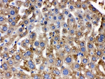 Catalase Antibody / Antioxidant Enzyme Antibody Human Liver Cancer IHC. Immunohistochemical staining of FFPE human liver cancer tissue using Catalase Antibody / Antioxidant Enzyme Antibody. Catalase expression is detected predominantly within the cytoplasm of tumor cells, consistent with its localization in peroxisomes and its role in detoxifying hydrogen peroxide to protect cells from oxidative stress. Heat-induced epitope retrieval was performed by boiling tissue sections in pH 6, 10 mM citrate buffer for 20 minutes and allowing them to cool prior to immunostaining.