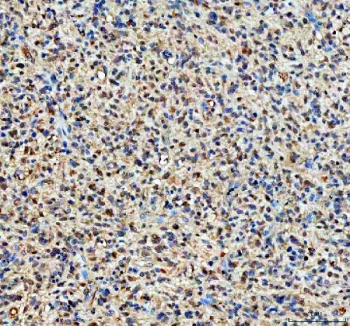 YAP1 Antibody Glioblastoma IHC. Immunohistochemical staining of FFPE human glioblastoma tissue demonstrates YAP1 expression using a YAP1 antibody. YAP1, also known as Yes Associated Protein 1, is a transcriptional coactivator and major Hippo pathway effector implicated in tumor growth and cell survival. Tumor cells exhibit predominantly nuclear and cytoplasmic staining, consistent with active YAP1 signaling frequently observed in glioblastoma and other malignancies. Heat induced epitope retrieval was performed by boiling tissue sections in pH8 EDTA buffer for 20 minutes followed by cooling prior to staining. These results support the utility of YAP1 Antibody for investigating Hippo pathway activity and oncogenic signaling in human cancers.
