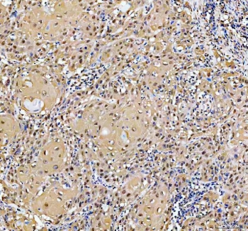 YAP1 Antibody Bladder Carcinoma IHC. Immunohistochemical staining of FFPE human invasive urothelial carcinoma of the bladder with squamous differentiation demonstrates YAP1 expression using a YAP1 antibody. YAP1, also known as Yes Associated Protein 1, is a transcriptional coactivator and key Hippo pathway effector associated with tumor progression, cellular plasticity, and therapeutic resistance. Strong nuclear and cytoplasmic staining is observed in neoplastic cells, consistent with activated YAP1 signaling reported in aggressive urothelial carcinomas and squamous tumors. Heat induced epitope retrieval was performed by boiling tissue sections in pH8 EDTA buffer for 20 minutes followed by cooling prior to staining. These results support the use of YAP1 Antibody for studying Hippo pathway activation and oncogenic signaling in bladder cancer.