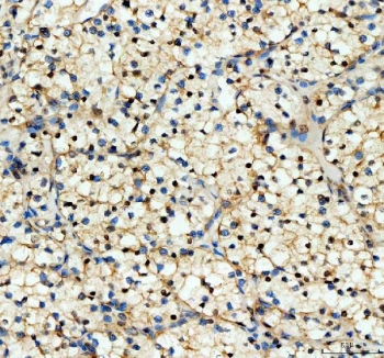 YAP1 Antibody Renal Clear Cell Carcinoma IHC. Immunohistochemical staining of FFPE human renal clear cell carcinoma (RNCC) tissue demonstrates YAP1 expression using a YAP1 antibody. YAP1, also known as Yes Associated Protein 1, is a transcriptional coactivator and key Hippo pathway effector involved in cell proliferation, survival, and tumor progression. Predominantly nuclear and cytoplasmic staining is observed in neoplastic cells, consistent with active YAP1 signaling reported in renal cell carcinoma and other malignancies. Heat induced epitope retrieval was performed by boiling tissue sections in pH8 EDTA buffer for 20 minutes followed by cooling prior to staining. These findings support the utility of YAP1 Antibody for investigating Hippo pathway activity and oncogenic signaling in human renal cancers.