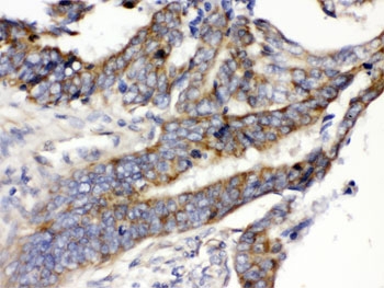 SLC2A5 Antibody Intestinal Cancer IHC. Immunohistochemical staining of FFPE human intestinal cancer tissue demonstrates SLC2A5 expression using an SLC2A5 antibody. SLC2A5, also known as GLUT5 and Sugar Transport Protein, is a facilitative transporter that mediates fructose uptake and contributes to cellular energy metabolism. Prominent membranous and cytoplasmic staining is observed in malignant epithelial cells, consistent with the increased nutrient requirements and metabolic reprogramming associated with cancer. Heat induced epitope retrieval was performed by boiling tissue sections in pH 6 10 mM citrate buffer for 20 minutes followed by cooling prior to staining. These results support the utility of SLC2A5 Antibody for studies of fructose transport, cancer metabolism, and nutrient homeostasis.