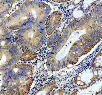 IHC staining of FFPE human colon cancer tissue with Perilipin 3 antibody, HRP-secondary and DAB substrate. HIER: boil tissue sections in pH8 EDTA for 20 min and allow to cool before testing.