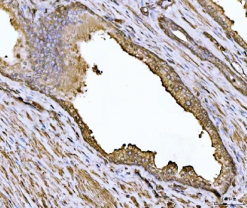 IHC staining of FFPE human prostate cancer tissue with ACTN4 antibody. HIER: boil tissue sections in pH8 EDTA for 20 min and allow to cool before testing.