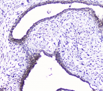 IHC staining of FFPE human breast cancer with Cdk6 antibody at 1ug/ml. HIER: boil tissue sections in pH6, 10mM citrate buffer, for 10-20 min followed by cooling at RT for 20 min.