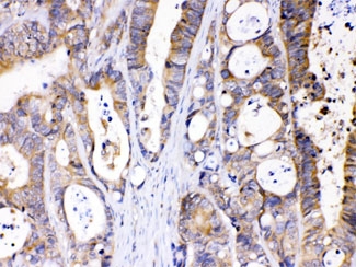 IHC testing of FFPE human intestinal cancer tissue with ABHD5 antibody at 1 ug/ml. HIER: steam sections in pH6 citrate buffer for 20 min.
