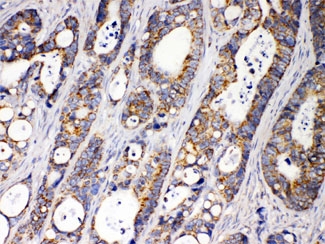 IHC testing of FFPE human intestinal cancer tissue with ACAA2 antibody at 1ug/ml. HIER: steam sections in pH6 citrate buffer for 20 min.