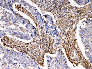 IHC testing of FFPE human lung cancer tissue with ACTN3 antibody at 1ug/ml. HIER: steam sections in pH6 citrate buffer for 20 min.