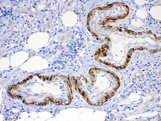 IHC testing of FFPE human intestinal cancer tissue with ACVR2A antibody at 1ug/ml. HIER: steam sections in pH6 citrate buffer for 20 min.