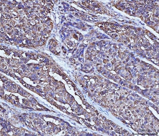 IHC testing of FFPE human liver cancer tissue with Alcohol dehydrogenase antibody. HIER: steam sections in pH8 EDTA buffer for 20 min.