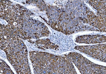 IHC staining of FFPE human hepatocellular carcinoma with ALDH1B1 antibody. HIER: boil tissue sections in pH8 EDTA for 20 min and allow to cool before testing.