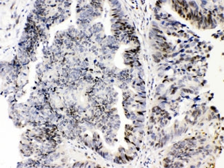E2F4 Antibody Intestine Cancer IHC. Immunohistochemistry testing of FFPE human intestinal cancer tissue with E2F4 antibody at 1ug/ml. HIER: steam section in pH6 citrate buffer for 20 min.