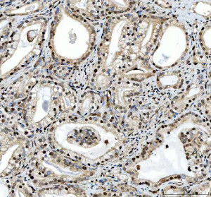 SAFB Antibody Human Prostate Cancer IHC. Immunohistochemical staining of FFPE human prostate cancer tissue demonstrated moderate to strong SAFB expression with predominant nuclear staining in malignant glandular epithelial cells and weaker staining of the surrounding stroma. Heat-induced epitope retrieval was performed in pH8 EDTA buffer before staining with the primary antibody and HRP-DAB detection. The nuclear localization is consistent with the role of Scaffold Attachment Factor in chromatin organization, transcriptional regulation and RNA processing. This SAFB Antibody, a Scaffold Attachment Factor Antibody, is suitable for immunohistochemical studies of nuclear protein expression in prostate cancer and gene regulation research.