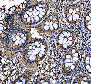 SAFB Antibody Human Colon Cancer IHC. Immunohistochemical staining of FFPE human colon cancer tissue demonstrated moderate to strong SAFB expression with predominantly nuclear staining in neoplastic epithelial cells and weaker staining in the surrounding stroma. Heat-induced epitope retrieval was performed in pH8 EDTA buffer before staining with the primary antibody and HRP-DAB detection. The nuclear localization is consistent with the established role of SAFB as a Scaffold Attachment Factor involved in chromatin organization, transcriptional regulation and RNA processing. This SAFB Antibody, a Scaffold Attachment Factor Antibody, is suitable for immunohistochemical studies of nuclear protein expression in cancer and gene regulation research.