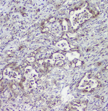 IHC staining of FFPE human intestinal cancer with MPI antibody at 1ug/ml. HIER: boil tissue sections in pH6, 10mM citrate buffer, for 10-20 min followed by cooling at RT for 20 min.