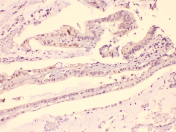 IHC testing of FFPE human intestinal carcinoma with HDGF antibody at 1ug/ml. HIER: steam section in pH6 citrate buffer for 20 min.