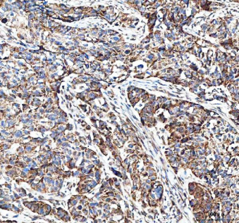 Immunohistochemical staining of FFPE human bladder urothelial carcinoma tissue with MUT antibody, HRP-secondary and DAB substrate. HIER: boil tissue sections in pH8 EDTA for 20 min and allow to cool before testing.