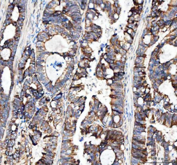 Immunohistochemical staining of FFPE human colorectal adenocarcinoma tissue with MUT antibody, HRP-secondary and DAB substrate. HIER: boil tissue sections in pH8 EDTA for 20 min and allow to cool before testing.