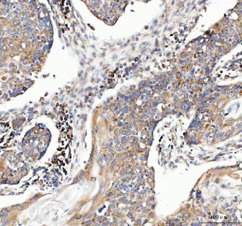 Immunohistochemical staining of FFPE human esophageal squamous carcinoma tissue with MUT antibody, HRP-secondary and DAB substrate. HIER: boil tissue sections in pH8 EDTA for 20 min and allow to cool before testing.