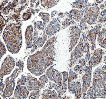 Immunohistochemical staining of FFPE human liver cancer tissue with MUT antibody, HRP-secondary and DAB substrate. HIER: boil tissue sections in pH8 EDTA for 20 min and allow to cool before testing.