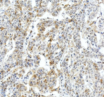 IHC staining of FFPE human liver cancer tissue with Fibrinogen beta chain antibody, HRP-secondary and DAB substrate. HIER: boil tissue sections in pH8 EDTA for 20 min and allow to cool before testing.