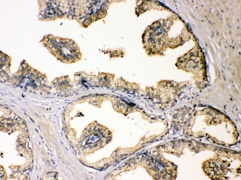 DBI Antibody Prostate Cancer IHC. Immunohistochemistry of FFPE human prostate carcinoma tissue using DBI antibody shows granular HRP-DAB brown cytoplasmic staining in tumor epithelial cells, consistent with DBI / Diazepam binding inhibitor expression associated with intracellular lipid metabolism, neurosteroid-related pathways, and acyl-CoA-binding activity. HIER: steam sections in pH6 citrate buffer for 20 min.