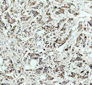 IHC staining of FFPE human breast cancer tissue with Hexokinase II antibody. HIER: boil tissue sections in pH8 EDTA for 20 min and allow to cool before testing.