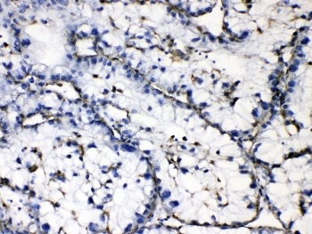 IHC testing of FFPE human liver cancer tissue with GAA antibody at 1ug/ml. HIER: steam section in pH6 citrate buffer for 20 min.