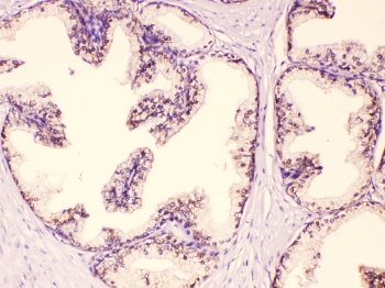 IHC testing of FFPE human prostate cancer tissue with GAA antibody at 1ug/ml. HIER: steam section in pH6 citrate buffer for 20 min.