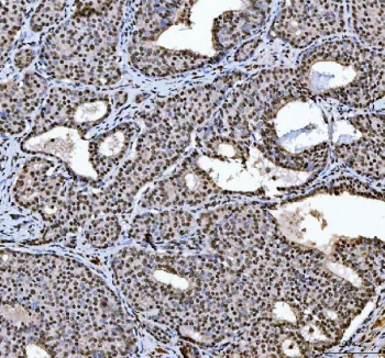 IHC staining of FFPE human breast cancer tissue with hnRNP L antibody. HIER: boil tissue sections in pH8 EDTA for 20 min and allow to cool before testing.