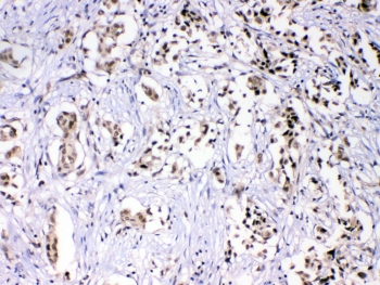 IHC testing of FFPE human breast cancer with hnRNP F antibody at 1ug/ml. HIER: steam section in pH6 citrate buffer for 20 min.