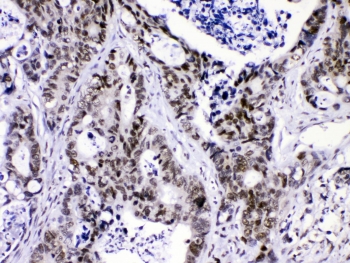 IHC testing of FFPE human intestinal cancer with hnRNP F antibody at 1ug/ml. HIER: steam section in pH6 citrate buffer for 20 min.