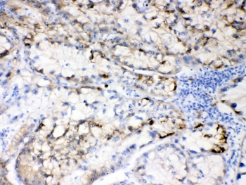 Hepatitis B Virus Antibody Human Liver Cancer IHC. Immunohistochemistry testing of FFPE human liver cancer tissue with Hepatitis B Virus antibody at 0.5ug/ml. HIER: steam section in pH6 citrate buffer for 20 min and allow to cool prior to testing.