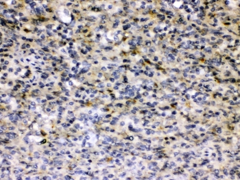 Hepatitis B Virus Antibody Hepatitis B+ Tissue IHC. Immunohistochemistry testing of FFPE human Hepatitis B+ tissue with Hepatitis B Virus antibody at 0.5ug/ml. HIER: steam section in pH6 citrate buffer for 20 min and allow to cool prior to testing.