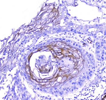 IHC testing of FFEP human esophagus squama cancer tissue with Periplakin antibody. Required HIER: steam section in pH8 EDTA for 20 min and allow to cool prior to testing.