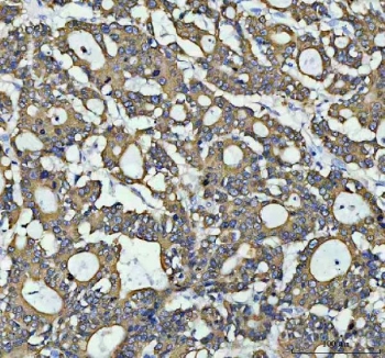 IHC staining of FFPE human colorectal adenocarcinoma tissue with AGR2 antibody. HIER: boil tissue sections in pH8 EDTA for 20 min and allow to cool before testing.