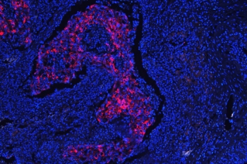 Immunofluorescent staining of FFPE human lung cancer with Cytokeratin 18 antibody (red) at 1ug/ml and DAPI nuclear stain (blue). HIER: steam section in pH6 citrate buffer for 20 min.