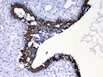Cytokeratin 8 Antibody Breast Cancer IHC. Immunohistochemical staining of FFPE human breast cancer tissue using Cytokeratin 8 Antibody at 1 Âµg/ml demonstrates strong membranous and cytoplasmic HRP-DAB brown staining within malignant epithelial cells lining glandular and duct-like tumor structures. The staining pattern is consistent with expression of Cytokeratin 8 (CK8/KRT8), a type II intermediate filament protein widely expressed in simple epithelial tissues and epithelial-derived carcinomas. Cytokeratin 8 immunoreactivity highlights neoplastic epithelial cell populations and supports evaluation of epithelial differentiation and tumor-associated architecture in breast cancer specimens. Required HIER: steam tissue sections in pH 6 citrate buffer for 20 minutes and allow to cool prior to testing.