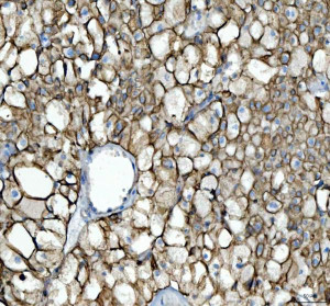 Cytokeratin 8 Antibody Human Kidney Cancer IHC. Immunohistochemical staining of FFPE human kidney cancer tissue using Cytokeratin 8 Antibody / KRT8 Antibody at 2 ug/ml. Heat-induced epitope retrieval was performed using pH8 EDTA buffer, followed by HRP-conjugated secondary antibody detection and DAB chromogen. Strong membranous and cytoplasmic staining is observed throughout the tumor cells, consistent with the expected localization of Cytokeratin 8. This Cytokeratin 8 Antibody, also called KRT8 Antibody, is suitable for studies of epithelial differentiation, intermediate filament organization, epithelial tumor biology, and Cytokeratin 8 protein localization.