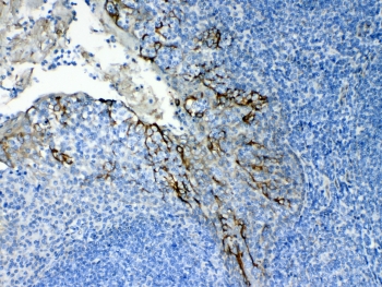Cytokeratin 8 Antibody Tonsil IHC. Immunohistochemical staining of FFPE human tonsil tissue using Cytokeratin 8 Antibody at 1 Âµg/ml demonstrates distinct membranous and cytoplasmic HRP-DAB brown staining within epithelial cell populations, while the surrounding lymphoid-rich regions remain largely negative. The staining pattern is consistent with expression of Cytokeratin 8 (CK8/KRT8), a type II intermediate filament protein expressed in simple epithelial tissues but not typically in lymphoid cells. Cytokeratin 8 immunoreactivity highlights epithelial structures within the tonsil and supports identification of epithelial differentiation in complex tissue specimens. Required HIER: steam tissue sections in pH 6 citrate buffer for 20 minutes and allow to cool prior to testing.