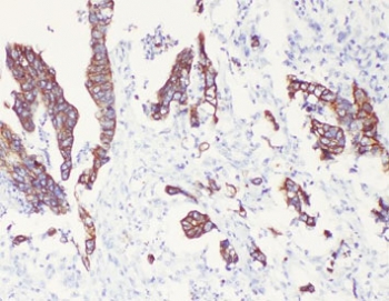Cytokeratin 8 Antibody Intestinal Cancer IHC. Immunohistochemical staining of FFPE human intestinal cancer tissue using Cytokeratin 8 Antibody at 1 Âµg/ml demonstrates strong membranous and cytoplasmic HRP-DAB brown staining within malignant epithelial cells forming glandular and tumor-associated epithelial structures. The staining pattern is consistent with expression of Cytokeratin 8 (CK8/KRT8), a type II intermediate filament protein widely expressed in simple epithelial tissues and epithelial-derived carcinomas. Cytokeratin 8 immunoreactivity highlights neoplastic epithelial differentiation and tumor architecture, supporting its utility as an epithelial lineage marker in intestinal cancer specimens. Required HIER: steam tissue sections in pH 6 citrate buffer for 20 minutes and allow to cool prior to testing.