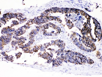 Cytokeratin 8 Antibody Intestinal Cancer IHC. Immunohistochemical staining of FFPE human intestinal cancer tissue using Cytokeratin 8 Antibody at 1 Âµg/ml demonstrates strong membranous and cytoplasmic HRP-DAB brown staining throughout malignant epithelial cells forming complex glandular and papillary tumor structures. The staining pattern is consistent with expression of Cytokeratin 8 (CK8/KRT8), a type II intermediate filament protein widely expressed in simple epithelial tissues and epithelial-derived carcinomas. Cytokeratin 8 immunoreactivity highlights neoplastic epithelial architecture and cellular differentiation, supporting its utility as an epithelial lineage marker in intestinal cancer specimens. Required HIER: steam tissue sections in pH 6 citrate buffer for 20 minutes and allow to cool prior to testing.