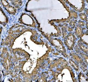 Cytokeratin 8 Antibody Human Thyroid Cancer IHC. Immunohistochemical staining of FFPE human thyroid cancer tissue using Cytokeratin 8 Antibody / KRT8 Antibody at 2 ug/ml. Heat-induced epitope retrieval was performed using pH8 EDTA buffer, followed by HRP-conjugated secondary antibody detection and DAB chromogen. Strong membranous and cytoplasmic staining is observed throughout the glandular tumor epithelium, consistent with the expected localization of Cytokeratin 8. This Cytokeratin 8 Antibody, also called KRT8 Antibody, is suitable for studies of epithelial differentiation, intermediate filament organization, epithelial tumor biology, and Cytokeratin 8 protein localization.