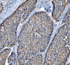 Cytokeratin 8 Antibody Human Liver Cancer IHC. Immunohistochemical staining of FFPE human liver cancer tissue using Cytokeratin 8 Antibody / KRT8 Antibody at 2 ug/ml. Heat-induced epitope retrieval was performed using pH8 EDTA buffer, followed by HRP-conjugated secondary antibody detection and DAB chromogen. Strong membranous and cytoplasmic staining is observed throughout the tumor cells, consistent with the expected localization of Cytokeratin 8. This Cytokeratin 8 Antibody, also called KRT8 Antibody, is suitable for studies of epithelial differentiation, intermediate filament organization, epithelial tumor biology, and Cytokeratin 8 protein localization.