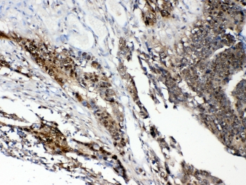 STAT1 Antibody Intestinal Cancer IHC. Immunohistochemistry staining of FFPE human intestinal cancer tissue using STAT1 antibody demonstrates strong cytoplasmic and nuclear staining within neoplastic epithelial cell populations, consistent with expression of Signal Transducer and Activator of Transcription 1 (STAT1). STAT1 is a key transcription factor within the JAK-STAT signaling pathway that mediates cellular responses to interferons, cytokines, and other extracellular signaling molecules. The observed staining pattern is consistent with the role of STAT1 in regulating transcriptional programs involved in immune responses, cellular signaling, differentiation, and tumor-associated signaling networks. These findings support the utility of STAT1 antibody for studies of signal transduction, immune regulation, and transcription factor expression in human tissues. Required HIER: steam section in pH6 citrate buffer for 20 min and allow to cool prior to testing.