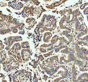 Immunohistochemical staining of FFPE human lung cancer tissue with ECE1 antibody, HRP-secondary and DAB substrate. HIER: boil tissue sections in pH8 EDTA for 20 min and allow to cool before testing.